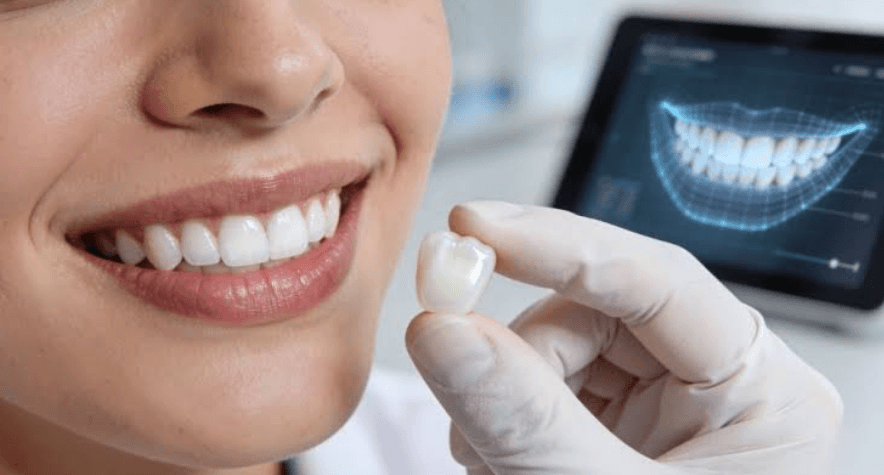 How General Dentists Check The Margins Of Veneers During Routine Examinations