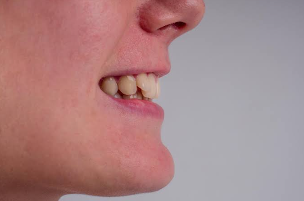 How Orthodontists Correct Bite Problems Caused By Uneven Tooth Eruption